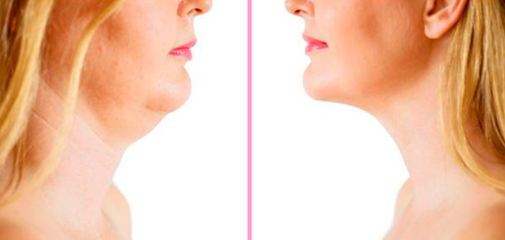 Cinta facial V Line Shaper para mulheres - Bandagem elástica de emagrecimento facial